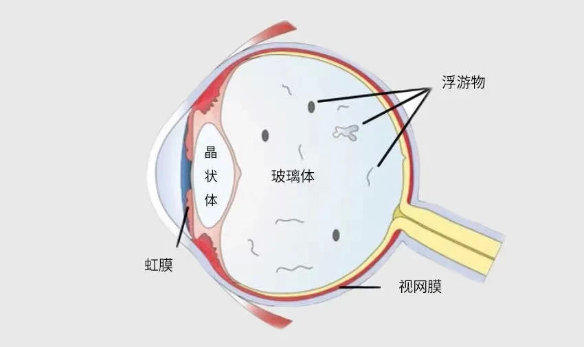 玻璃体混浊最新特效药的探索与奇妙之旅