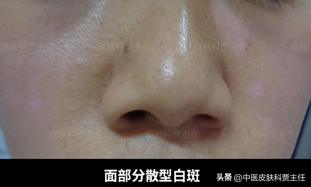 白癜风最新治疗资讯与进展