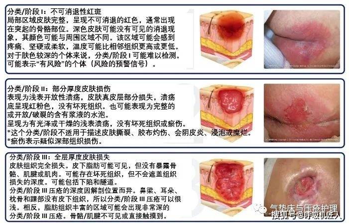 最新压疮分期及护理，背景、进展、地位全解析